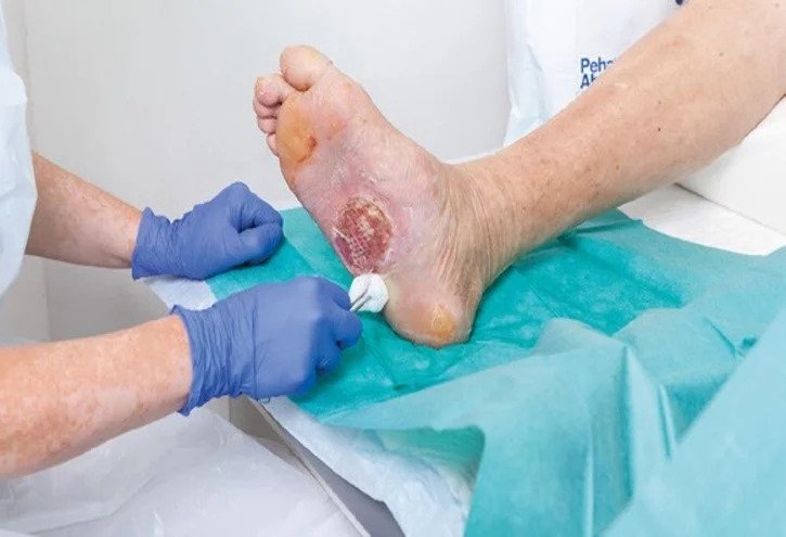 Debridement & Dressing - Velura Clinic
